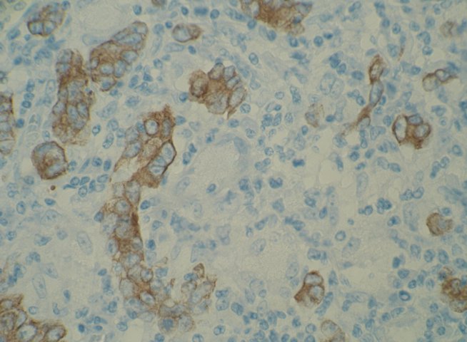 Figura 21. Inmunohistoqumica CTK AE1/AE3 positiva en clulas neoplsicas (detalle de la figura anterior). Se destaca la negatividad en clulas gigantes de ncleos perifricos (tipo Langhans). 400x